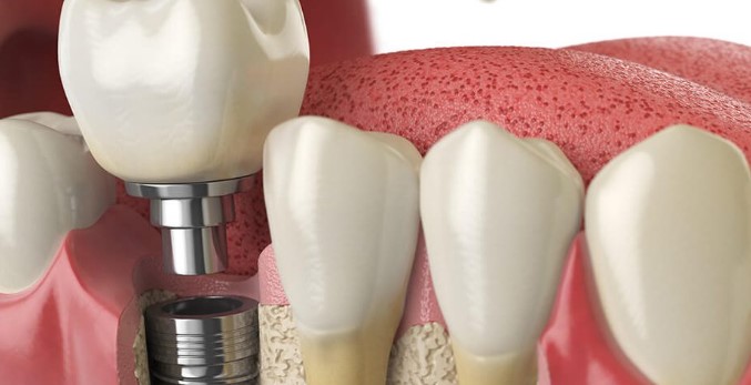 Unveiling the Wonders of Dental Implants