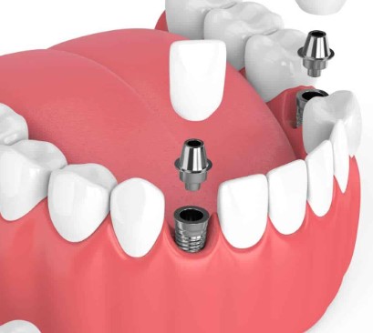 Unveiling The Wonders Of Dental Implants, Revealing The Magic Of Dental Implants, Exploring The Marvels Of Dental Implants, Delving Into Dental Implants